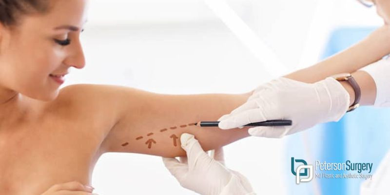 Body Contouring: Arm Lift Surgery Or Arm Liposuction?